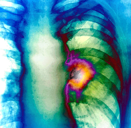 Image: Colored X-ray of the left lung in a patient with lung cancer (Photo courtesy of Zephyr / SPL). Image: Colored X-ray of the left lung in a patient with lung cancer (Photo courtesy of Zephyr / SPL).